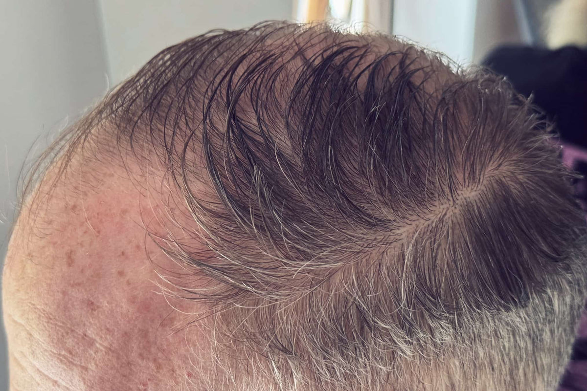 Oily Hair: Causes and What Really Helps